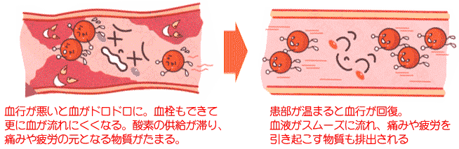 背中の痛みの主な治療法３ 体を温めて血液の流れ 血行 を良くする 温熱療法